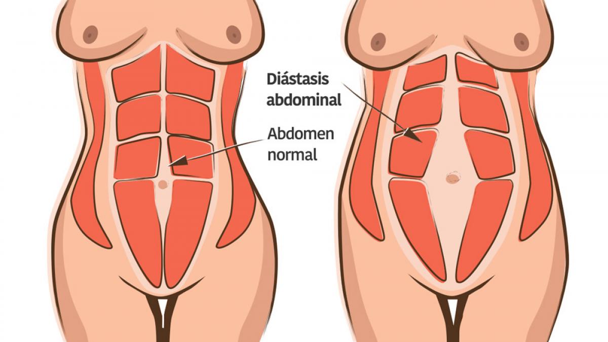 diastasis_2.jpg