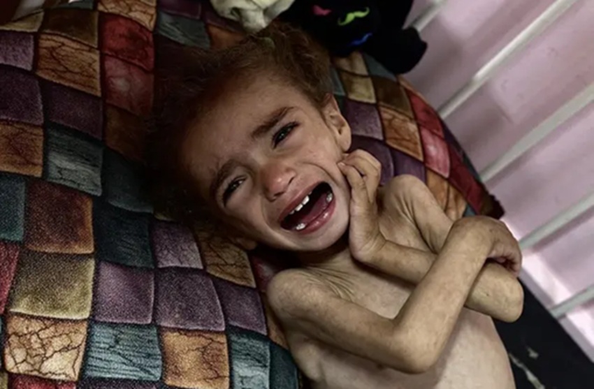 Niño desnutrido llorando